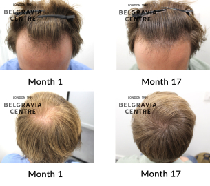 male pattern hair loss the belgravia centre 439816