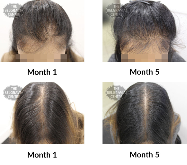female pattern hair loss the belgravia centre 332045 23 04 2020