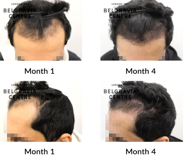 male pattern hair loss the belgravia centre 433965