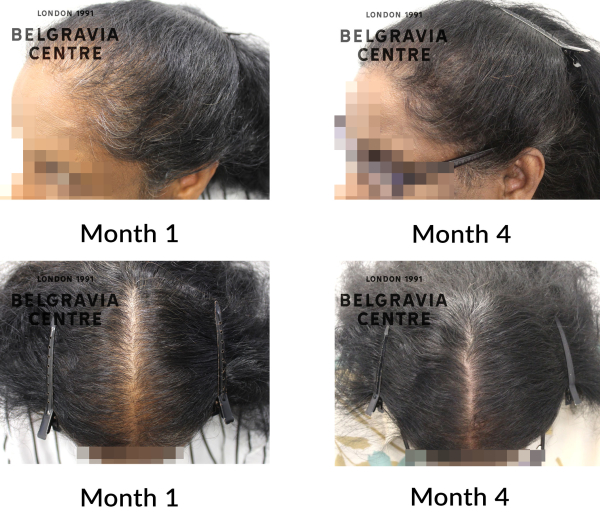 female pattern hair loss the belgravia centre 463299