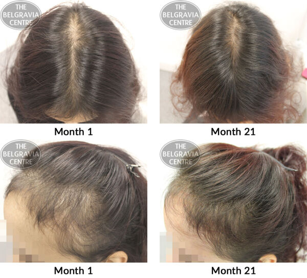 female pattern hair loss the belgravia centre pk 13 11 2017