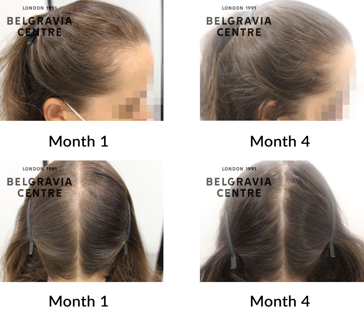 female pattern hair loss the belgravia centre 426586