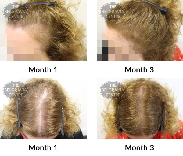 female pattern hair loss the belgravia centre 376333 01 04 2019
