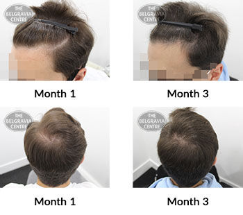 alert male pattern hair loss the belgravia centre 426991 05 11 2021