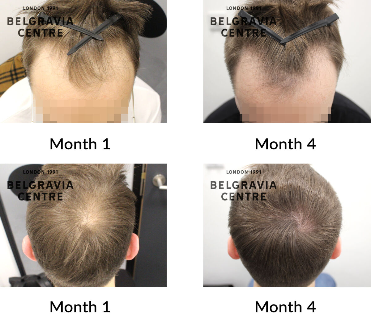 male pattern hair loss the belgravia centre 436487