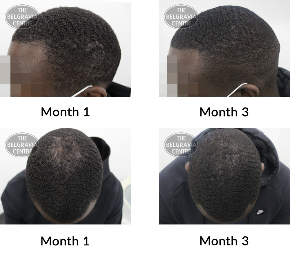 male pattern hair loss the belgravia centre 410213 28 09 2021