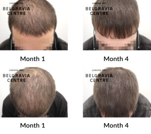 male pattern hair loss the belgravia centre 448797