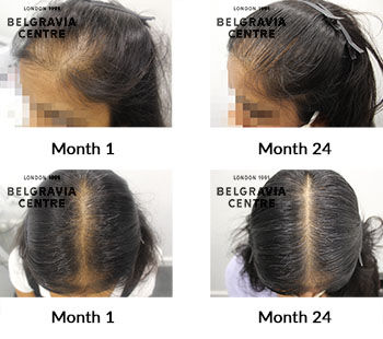 alert female pattern hair loss and follicular degeneration syndrome 396177
