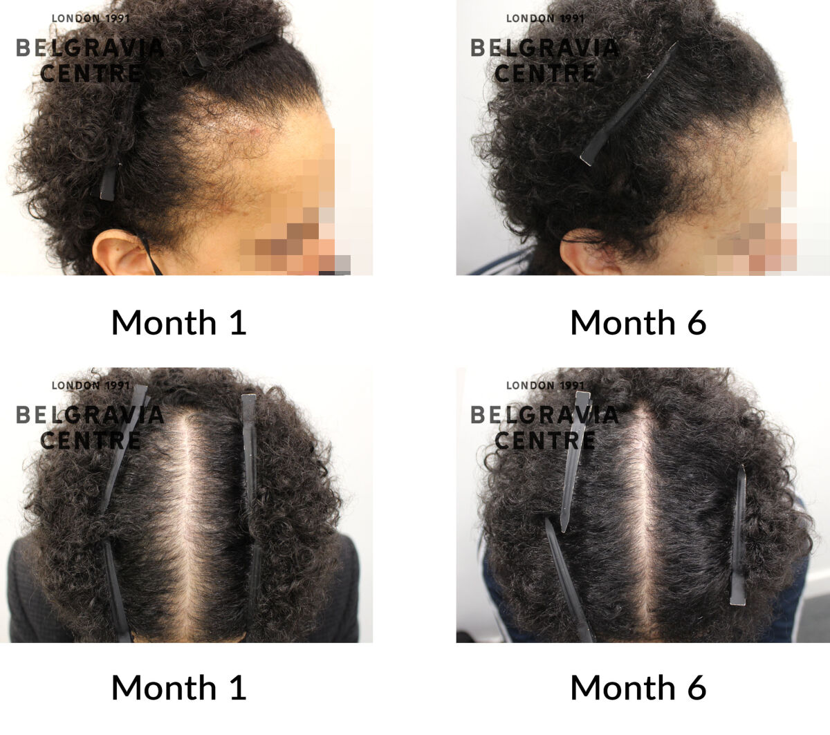 male pattern hair loss the belgravia centre 433733