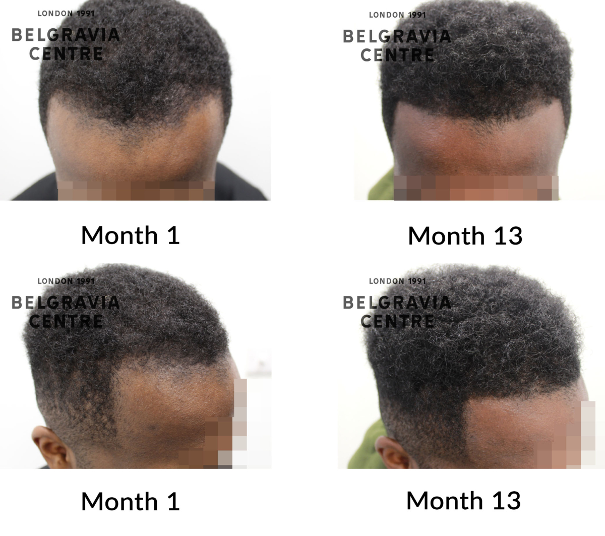 male pattern hair loss the belgravia centre 451422
