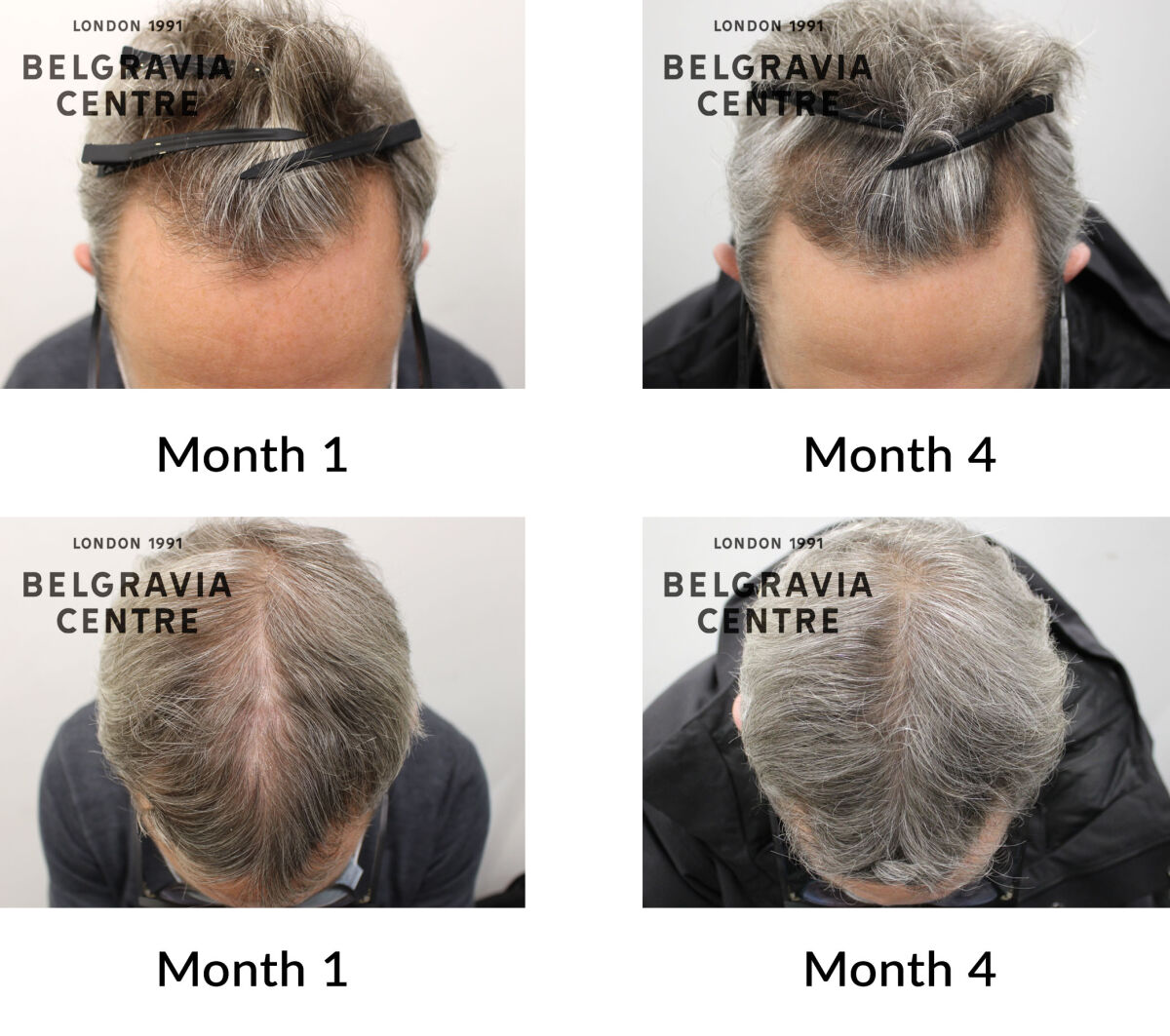 male pattern hair loss the belgravia centre 431101