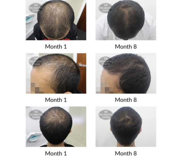 male pattern hair loss the belgravia centre 397286 30 10 2020