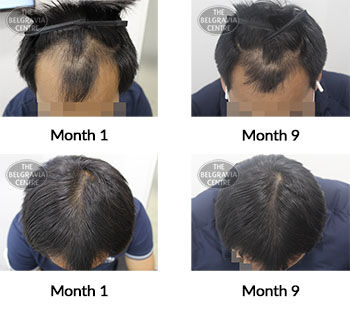 alert male pattern hair loss the belgravia centre 404253 22 04 2021