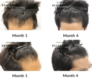 male pattern hair loss the belgravia centre 466638