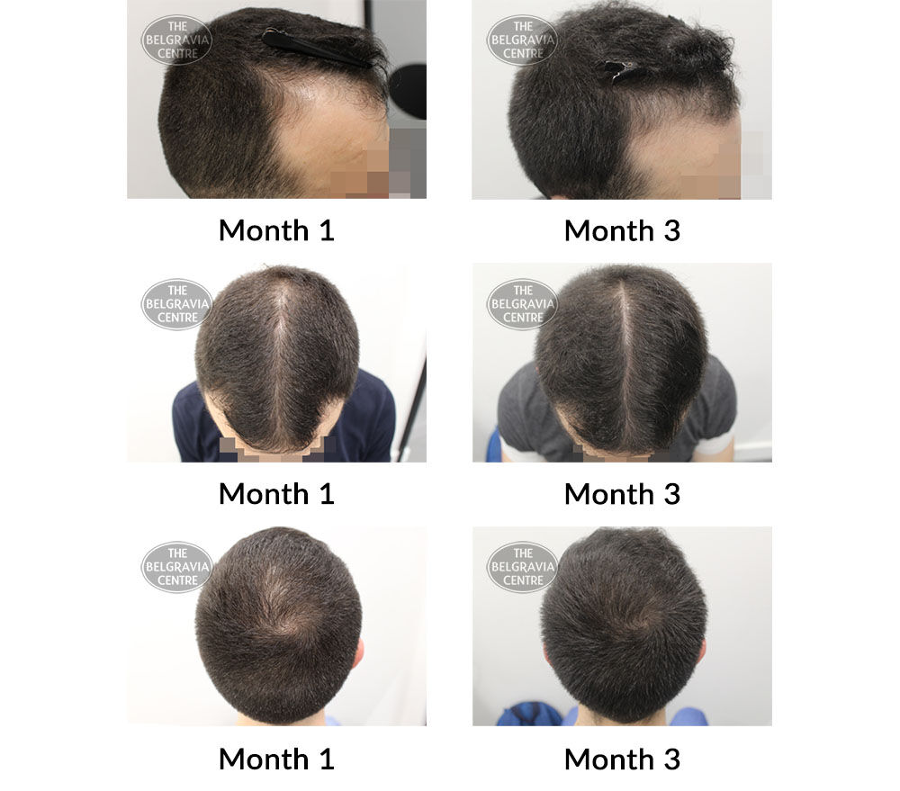 male pattern hair loss the belgravia centre 424675 23 09 2021