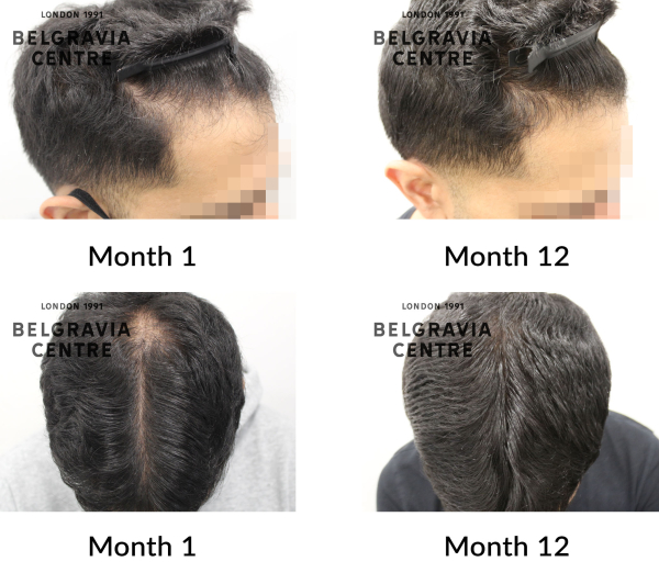 male pattern hair loss the belgravia centre 429110