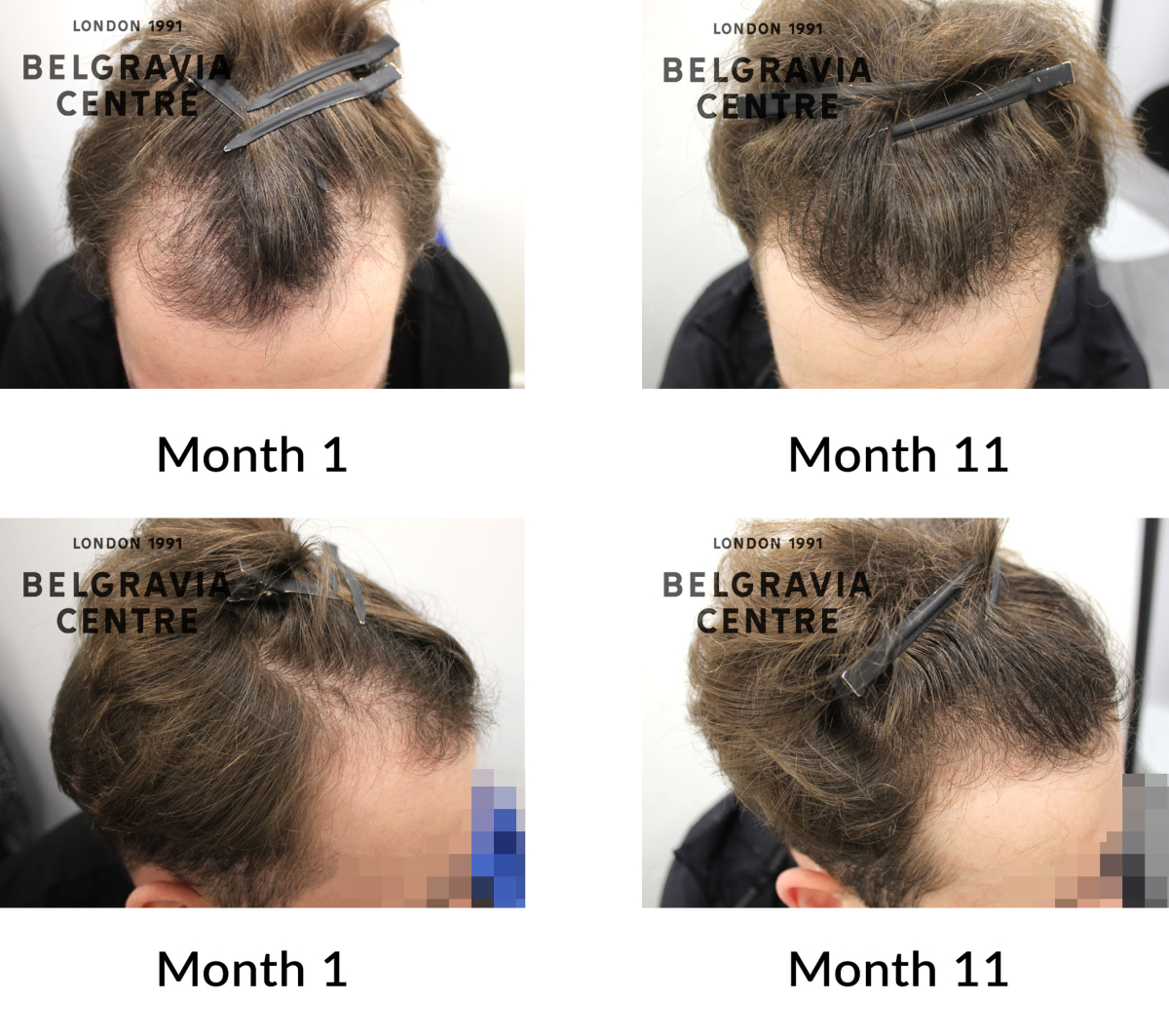 male pattern hair loss the belgravia centre 449880