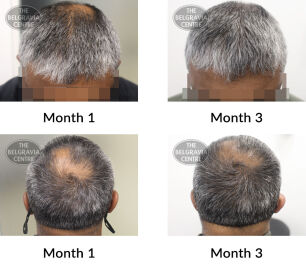 male pattern hair loss the belgravia centre 425249 20 10 2021