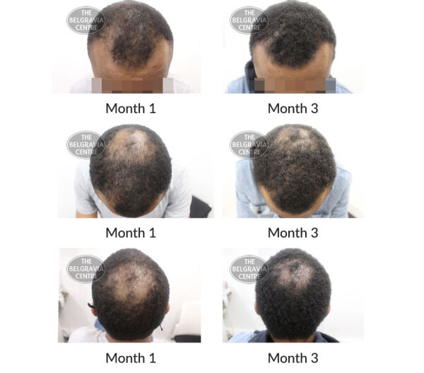 male pattern hair loss the belgravia centre 405966 23 10 2020