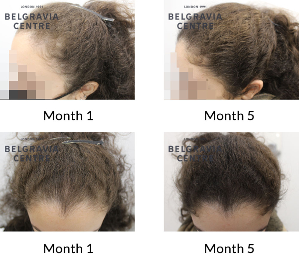 female pattern hair loss the belgravia centre 429480