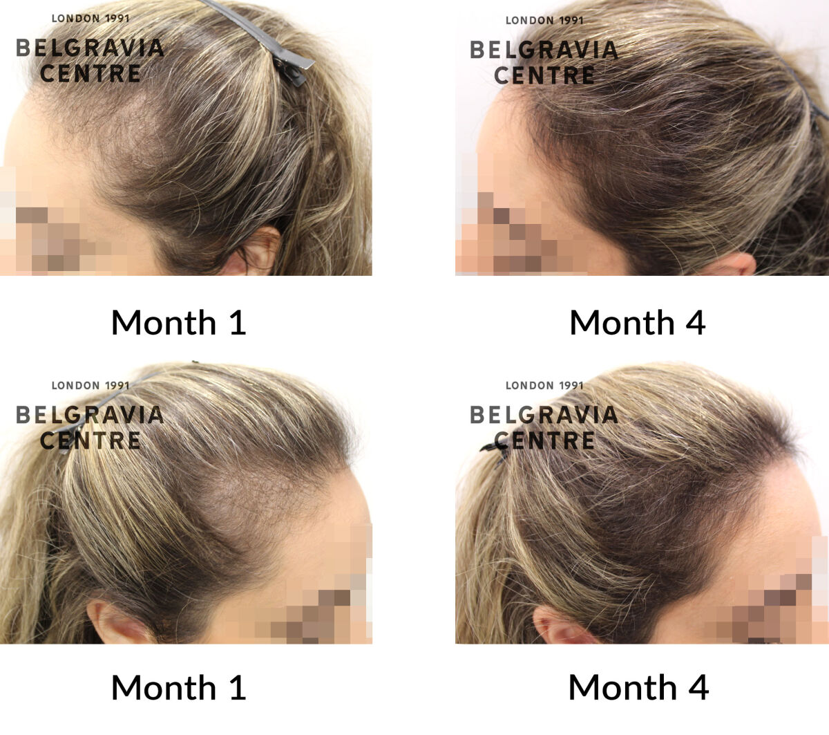 female pattern hair loss the belgravia centre 412583