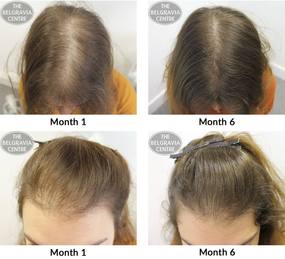 female pattern hair loss the belgravia centre MMIA 31 03 17