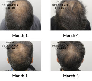 male pattern hair loss the belgravia centre 448188