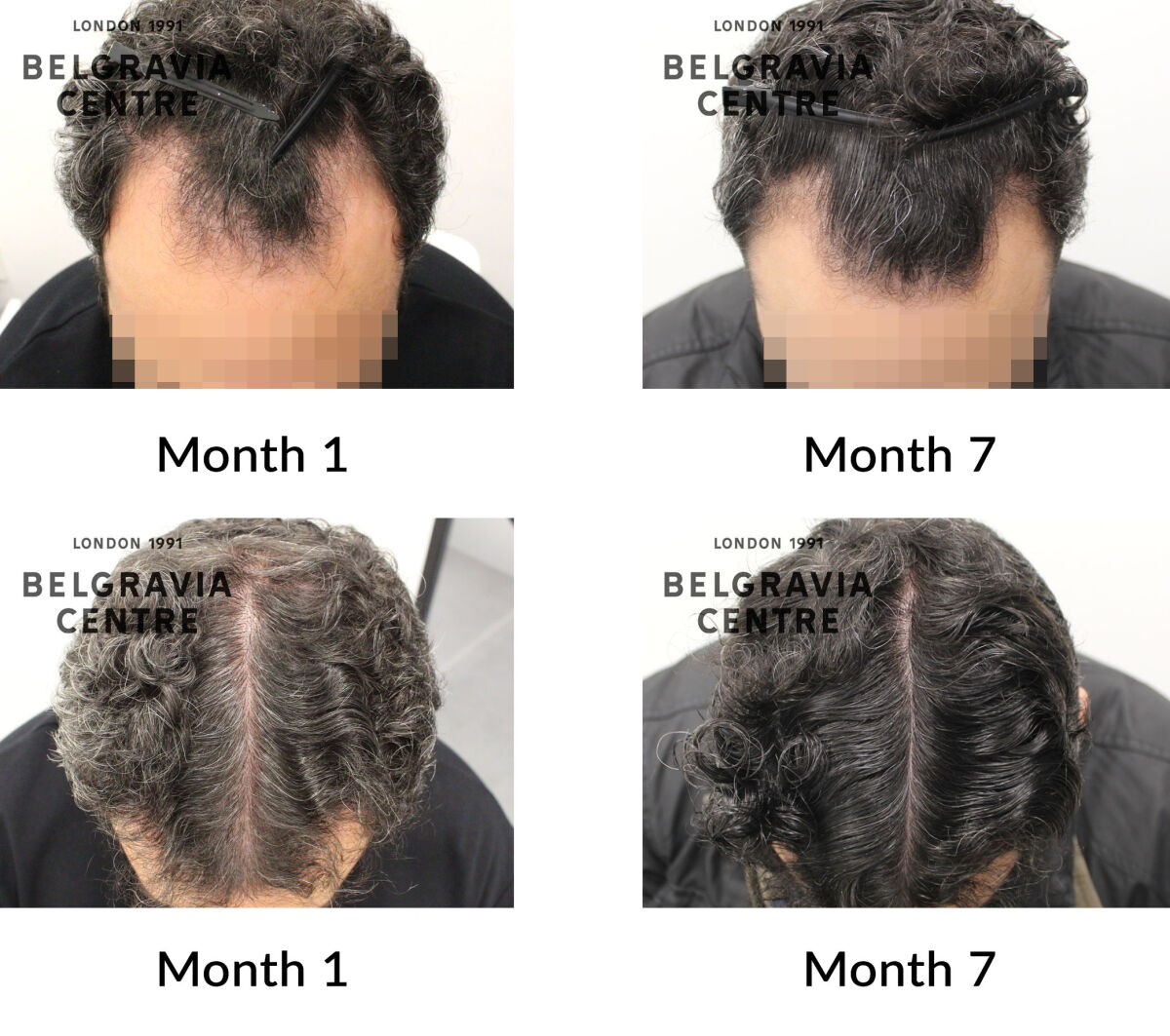 male pattern hair loss the belgravia centre 442900