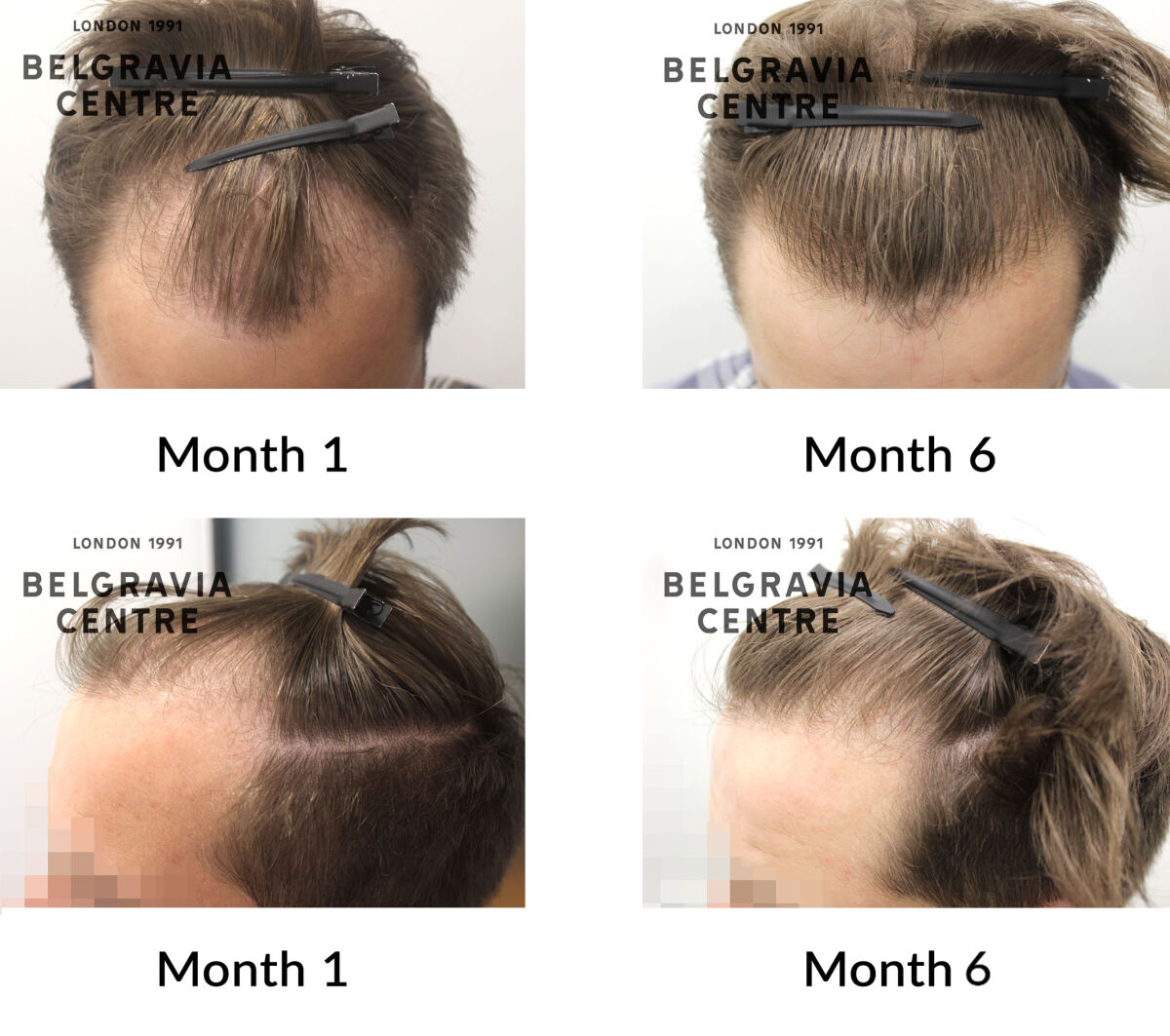 male pattern hair loss the belgravia centre 445795