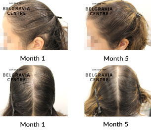 female pattern hair loss and diffuse thinning 467397