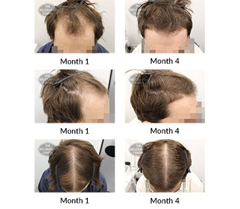 alert male pattern hair loss the belgravia centre 315216 16 01 2019