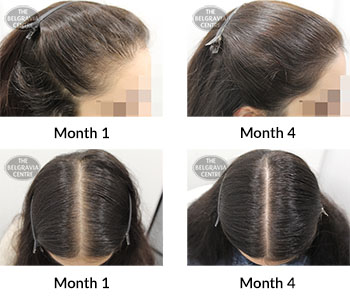 alert female pattern hair loss the belgravia centre 388230 16 01 2019