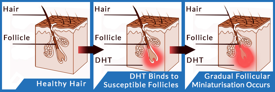 Diagram of Follicular Miniaturisation hair follicel shrinkage from genetic hair loss male pattern baldness