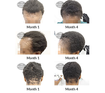 alert traction alopecia female pattern hair loss and follicular degeneration syndrome the belgravia centre 389405 09 01 2019
