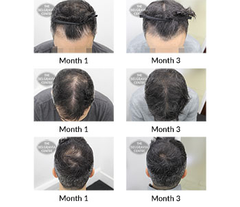 alert male pattern hair loss the belgravia centre 391080 07 01 2019