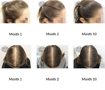 alert female pattern hair loss the belgravia centre 380754 31 12 2019