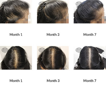 alert female pattern hair loss the belgravia centre 381663 30 12 2019