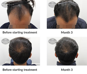 alert male pattern hair loss the belgravia centre 388788 23 12 2019