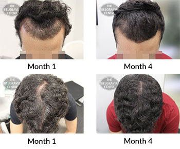 alert male pattern hair loss the belgravia centre 379943 17 12 2019