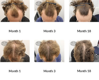 alert male pattern hair loss the belgravia centre 364938 16 12 2019