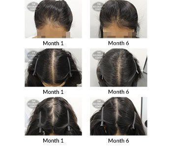 alert female pattern hair loss and diffuse hair loss the belgravia centre 383613 06 12 2019