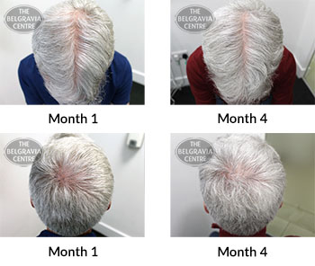 alert male pattern hair loss the belgravia centre 388776 05 12 2019
