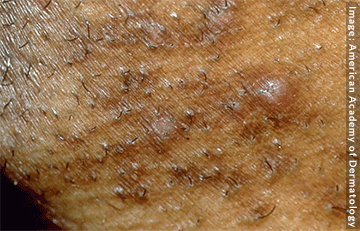 Example of folliculitis beard area