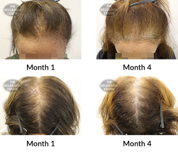 alert female pattern hair loss the belgravia centre 387981 29 11 2019