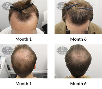 alert male pattern hair loss the belgravia centre 383362 02 12 2019
