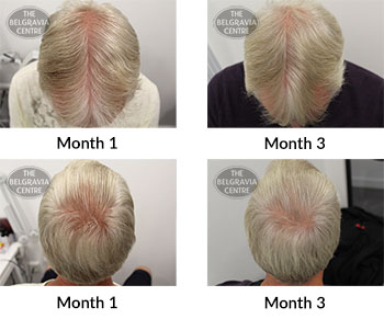 alert male pattern hair loss the belgravia centre 387616 28 11 2019