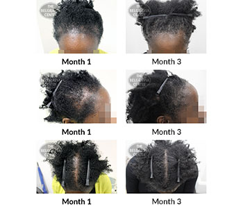 alert follicular degeneration syndrome traction alopecia and female pattern hair loss the belgravia centre 387538 27 11 2019