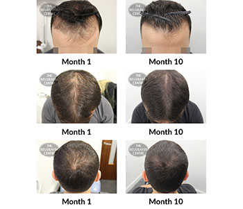 alert male pattern hair loss the belgravia centre 377365 27 11 2019