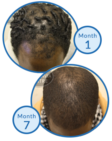 Mens hair loss Afro Hair Traction Alopecia Treatment Success Story Belgravia Centre Clinic