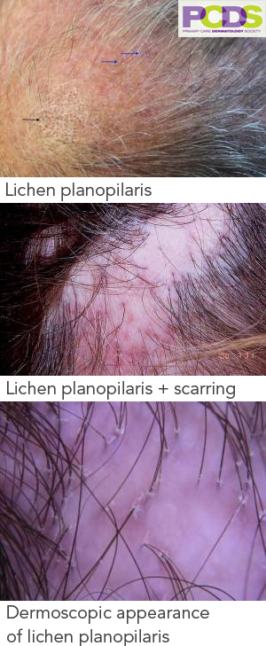 Examples of hair loss from Lichen Planopilaris - cicatricial alopecia